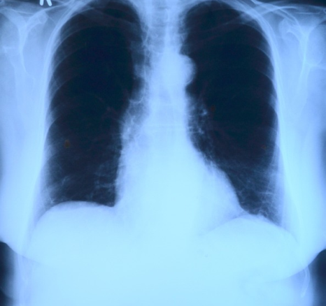 Pneumonia Management through Treatment and Minocycline