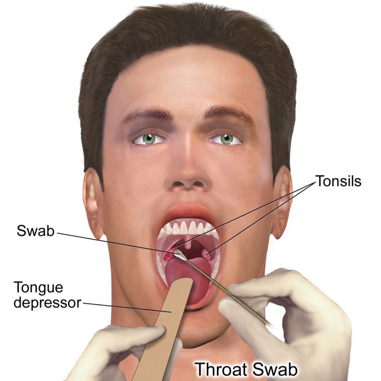 Strep Throat Symptoms Causes Diagnosis Treatment And Prevention 9161