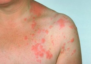 Shingles Symptoms