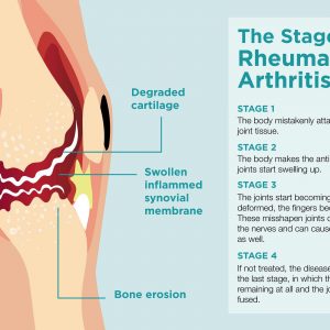 what are the 4 stages of rheumatoid arthritis