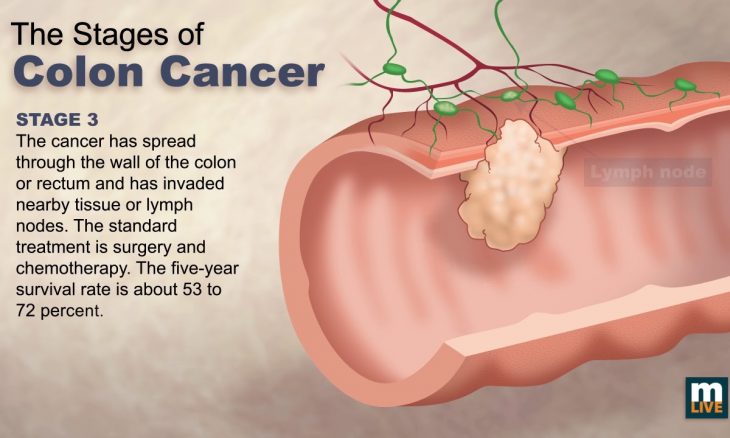 stage 4 colon cancer