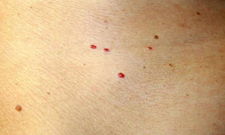 Red spots on skin