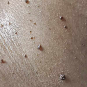 what causes skin tags