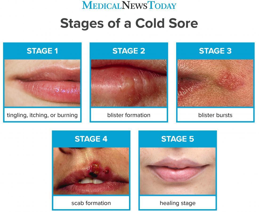 Cold Sore On Lip Cold Sore On Lip Cold Sore On Lip Cold Sore On Lip