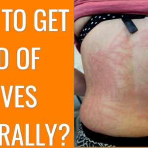 how to get rid of hives
